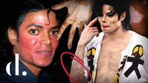 More Than Skin Deep: The Medical Truth About Michael Jackson’s Vitiligo